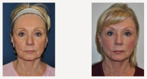 This case shows a good example of the subtle rejuvenation a natural-looking facelift should create.