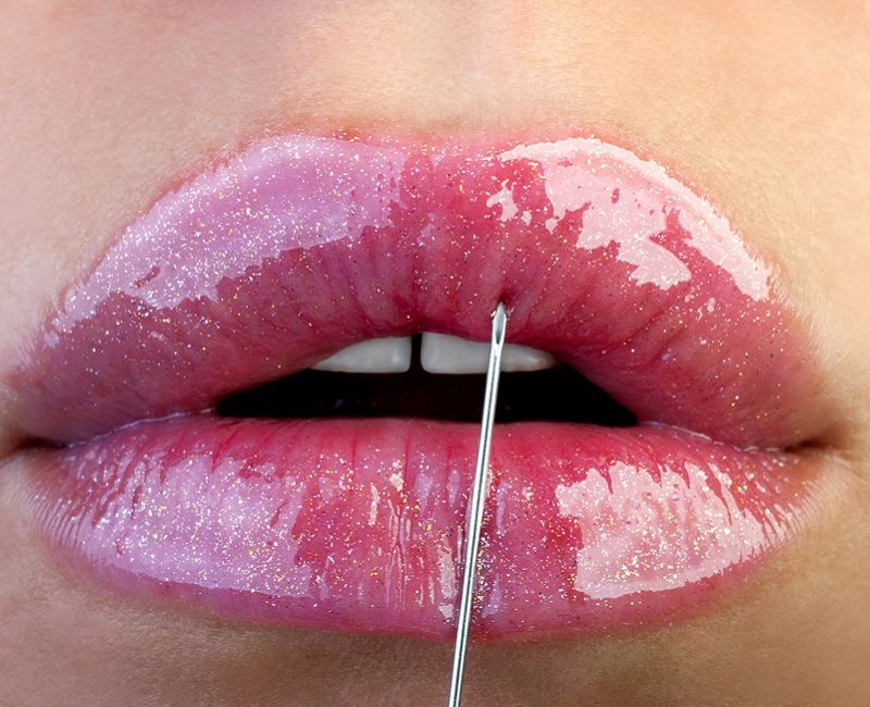 woman getting lip injections