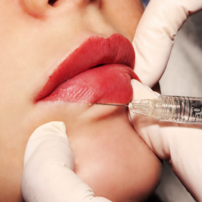 A close up of a woman's lips being injected with filler.